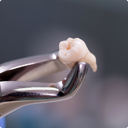 Close up of a tooth held by a set of dental forceps